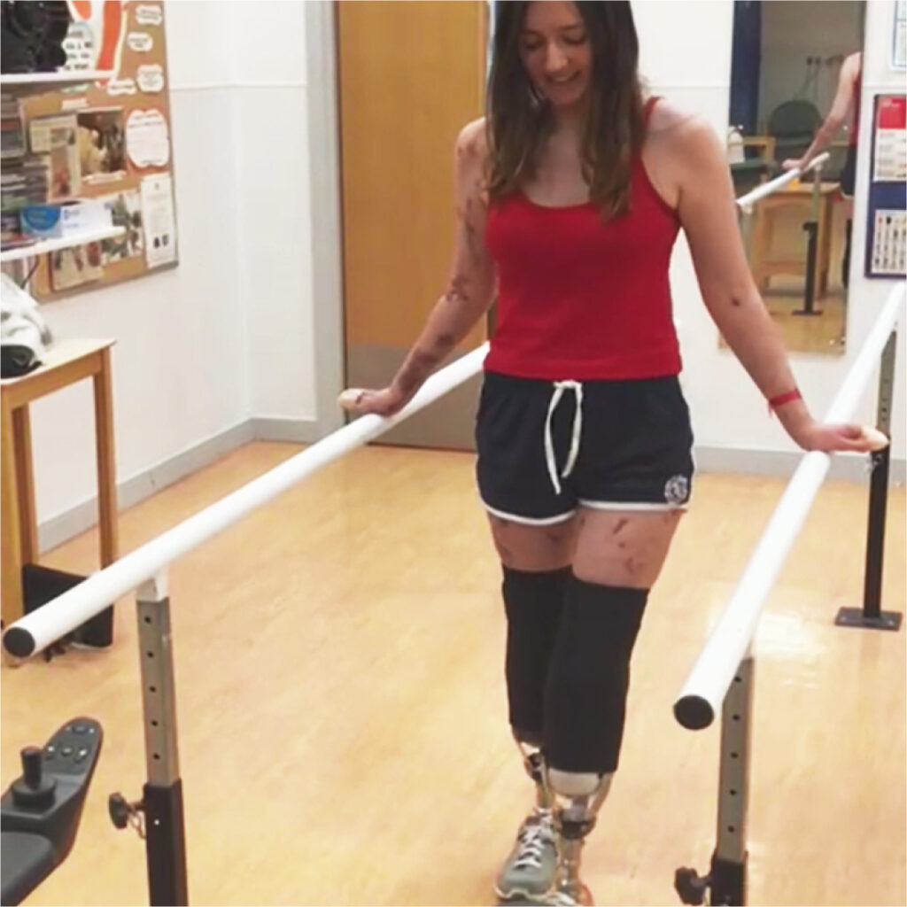 An image of Becca, walking between two parallel bars as part of her physiotherapy- steadying herself with her hands. She looks down at her path, as she practices walking with leg protheses.